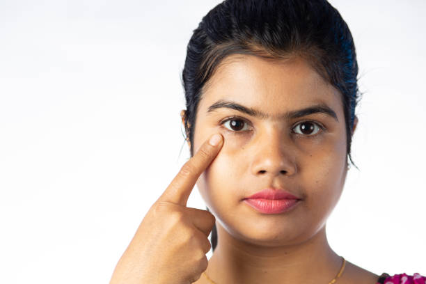 Rid of Dark Circles Naturally