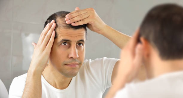 Dealing with Hair Loss: Solutions and Confidence Boosters