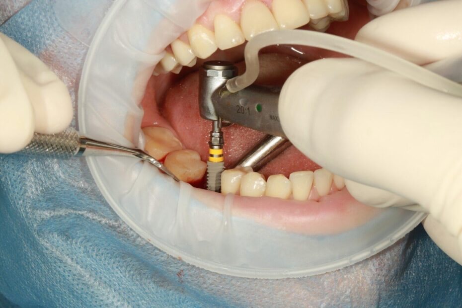 Guide to Dental Implants