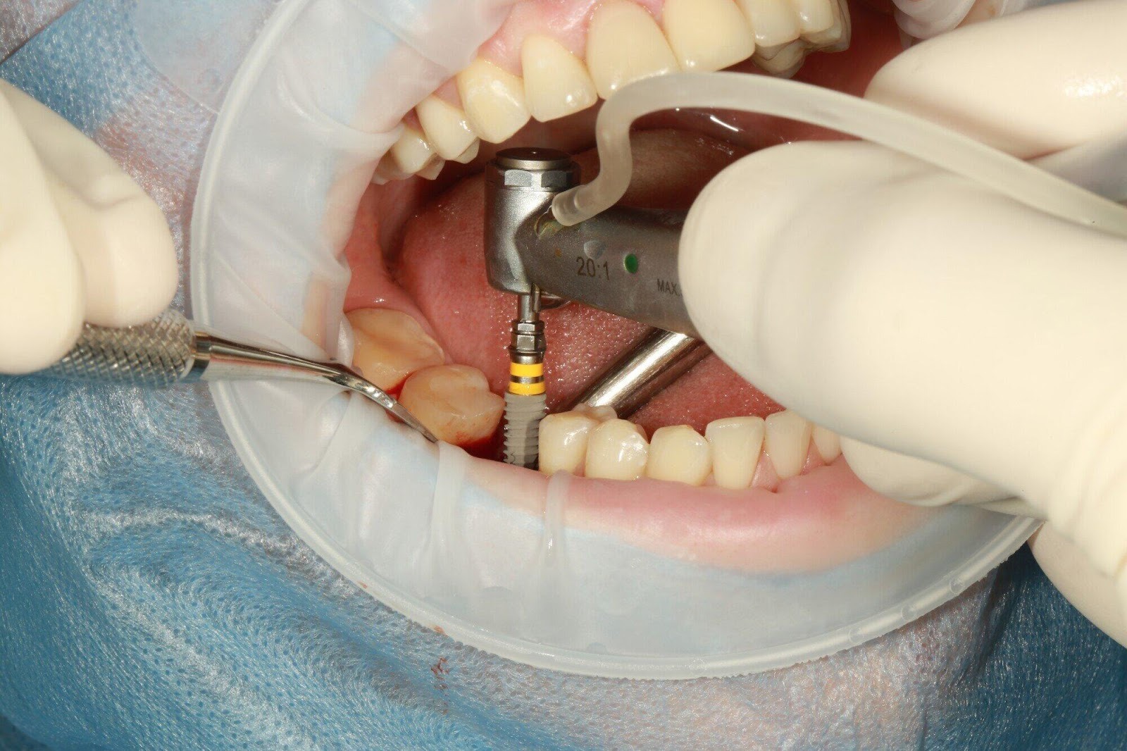 Guide to Dental Implants