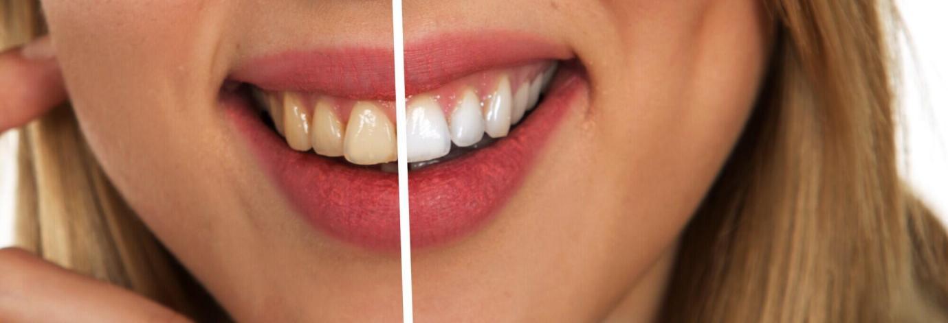 Enhancing Your Smile