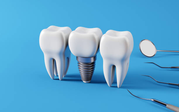 Behind Long-Lasting Dental Implants