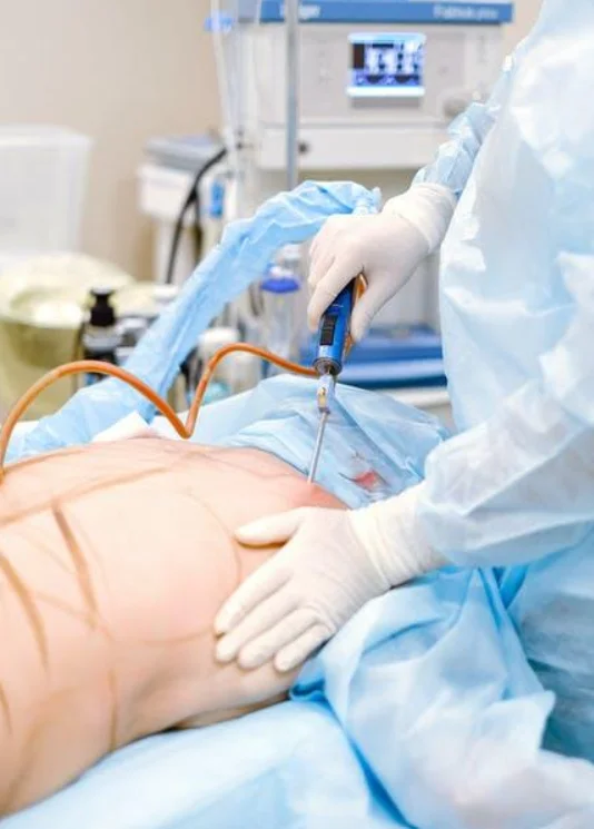 Liposuction Myths Vs. Reality